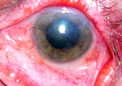 Close-up of an eye after stem cell transplantation.