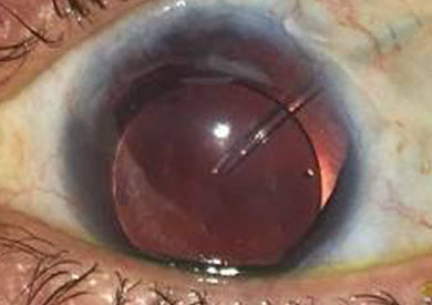 Close-up of an eye after stem cell transplantation.