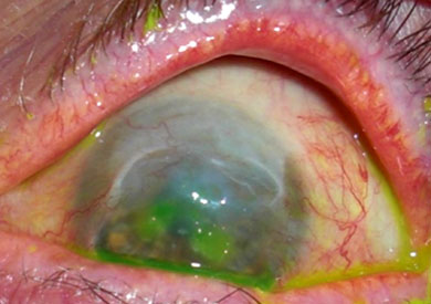Close-up of an eye with severe limbal stem cell deficiency.