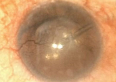 Close-up of an eye with severe limbal stem cell deficiency.