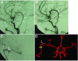 Blood flow in a Moyamoya patient