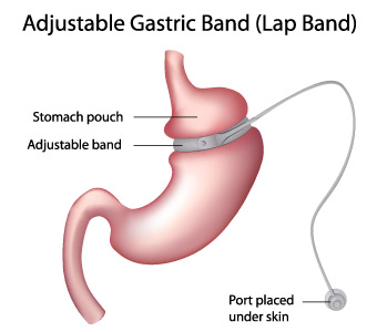 Adjustable Gastric Band (Lap Band)